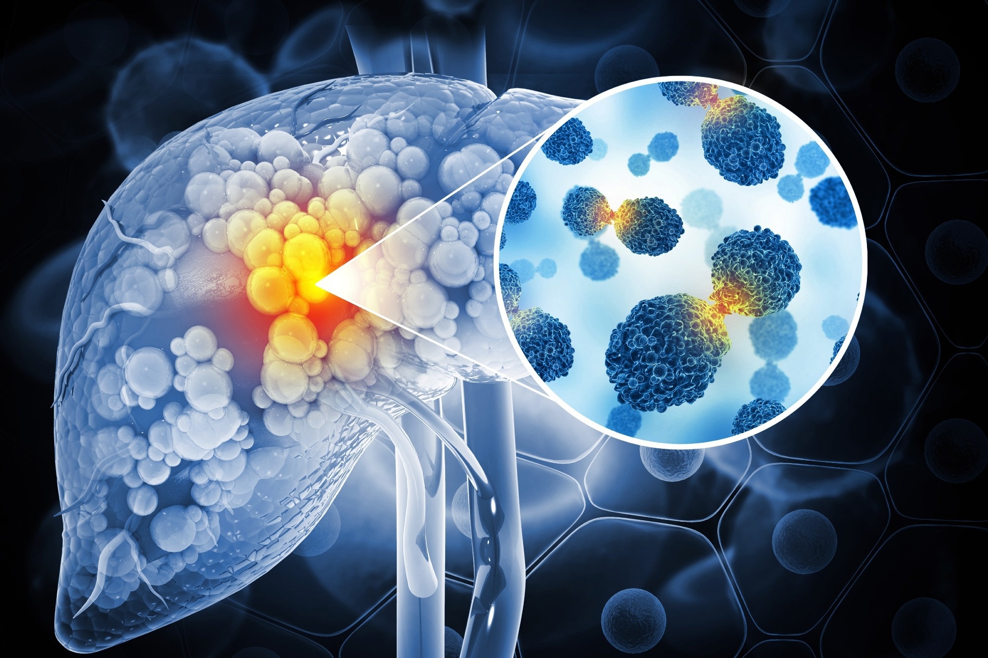 Ultrasound-activated Nanoparticles Kill Liver Cancer and Activate Immune System