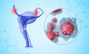 Polymer-Coated Nanoparticles Target and Clear Disseminated Ovarian Cancer