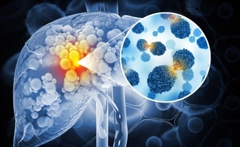Ultrasound-activated Nanoparticles Kill Liver Cancer and Activate Immune System